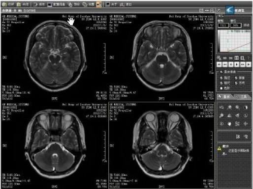 蒙妮脑部CT扫描结果